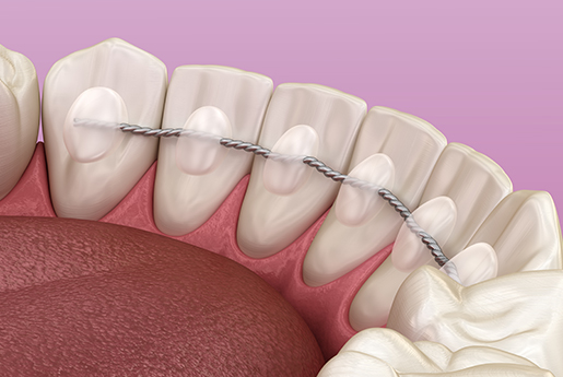 Orthodontische retainers